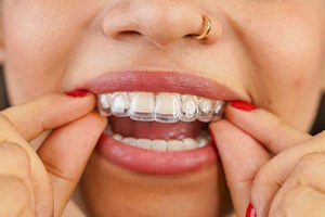 Close-up of person placing Invisalign aligner on teeth
