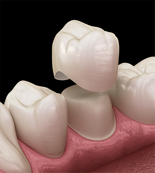 Digital image of a dental crown