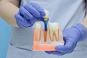 A dentist using a jawbone model to demonstrate how dental implants work