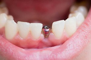 A closeup of a single tooth implant’s abutment