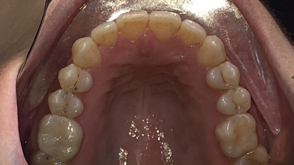 Smile with teeth in proper alignment