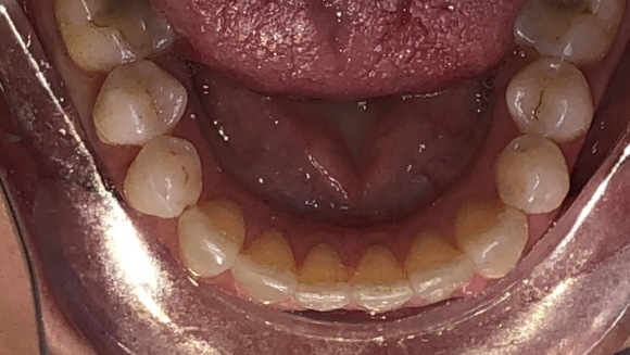 Smile with teeth in proper alignment