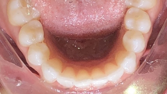 Smile with teeth in proper alignment