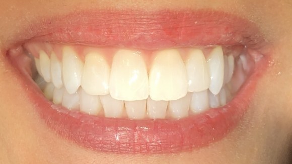 Smile with teeth in proper alignment