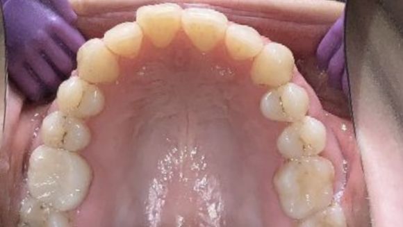 Smile with one tooth pushed back