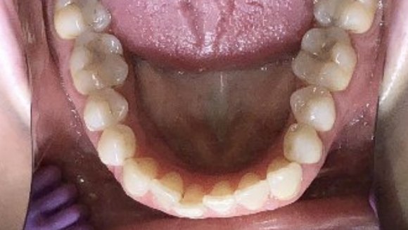 Smile with one tooth pushed back
