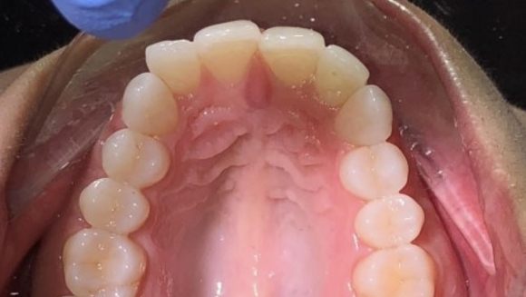 Smile with one tooth pushed back