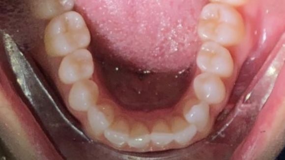 Smile with one tooth pushed back