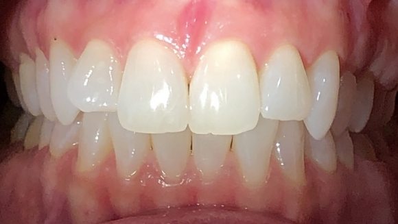 Smile with one tooth pushed back