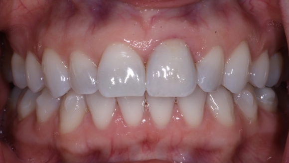 Smile after dental treatment