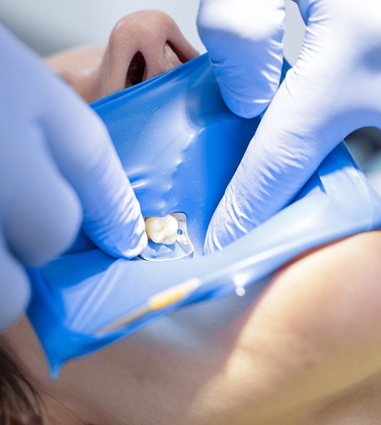 Patient undergoing a root canal