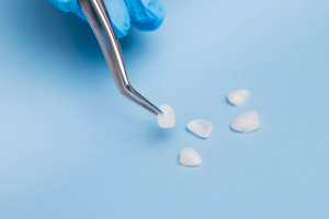 Picking up one of five veneers with metal tweezers