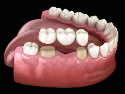 Multiple crowns being place on teeth, encino ca