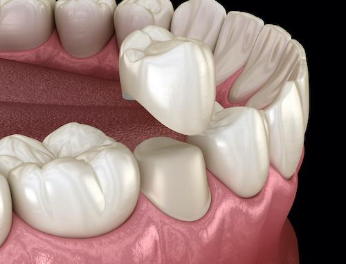 Dental crown being placed on a tooth, encino ca