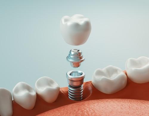 Dental implant being placed into tooth, encino ca