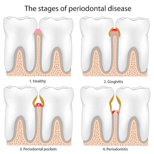 Stages of periodontal disease, encino ca