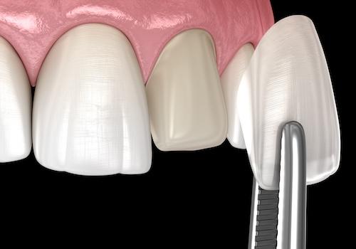 Veneer being placed on front tooth, encino ca