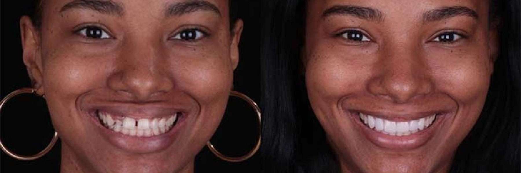 Get a Smile Makeover in Los Angeles