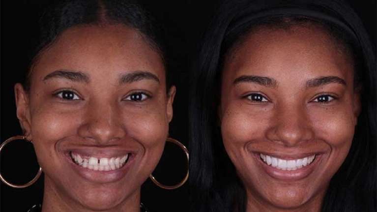Get a Smile Makeover in Los Angeles