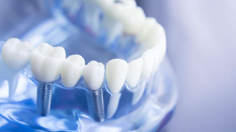 long-lasting, natural-looking solution: affordable dental implants in West LA