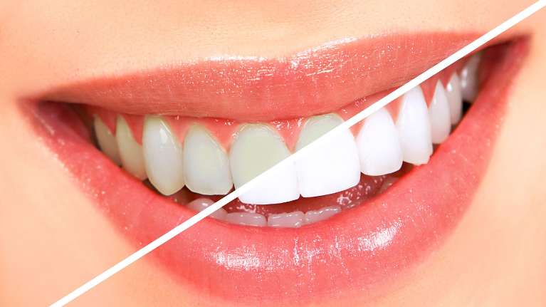 teeth whitening near me