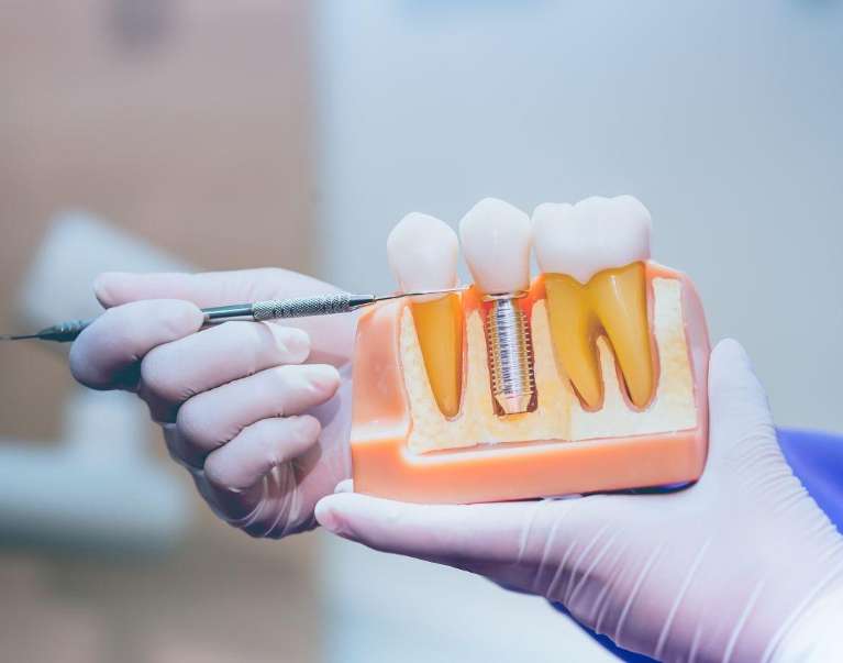 Dental implant in someones hands, encino ca