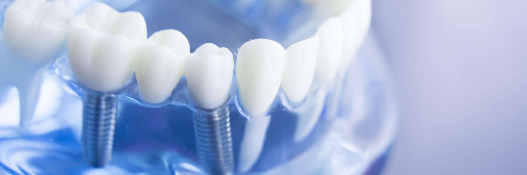 long-lasting, natural-looking solution: affordable dental implants in West LA