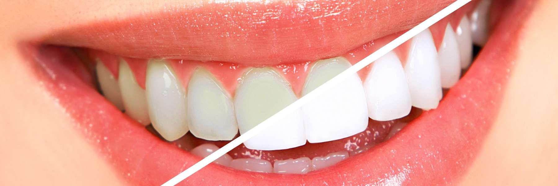 teeth whitening near me