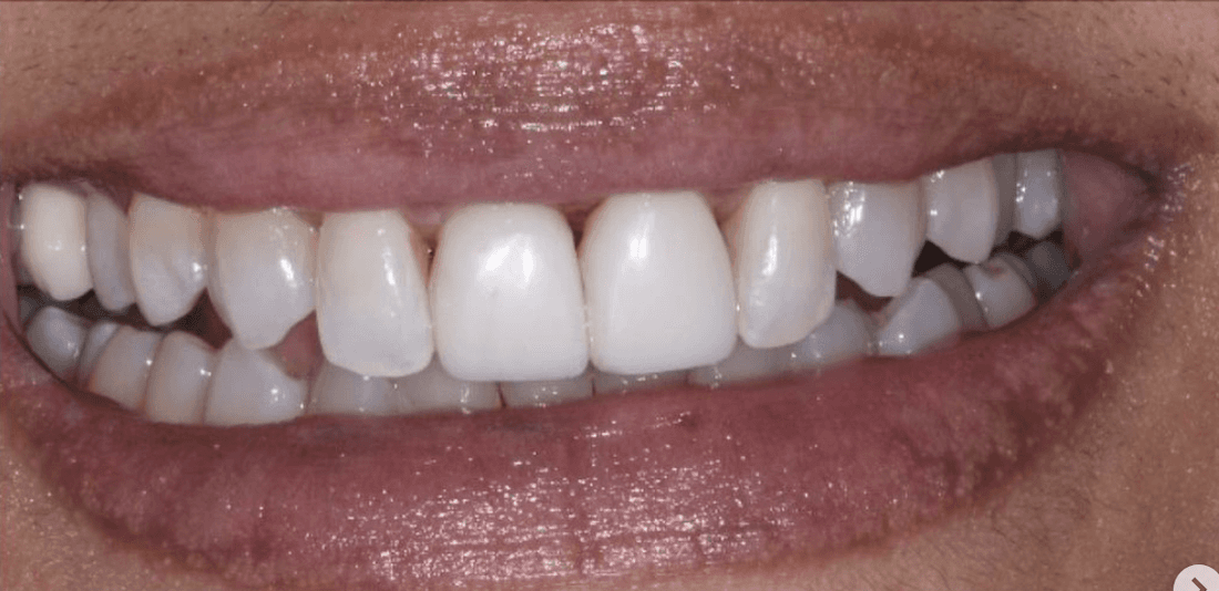 After composite bondings, encino ca