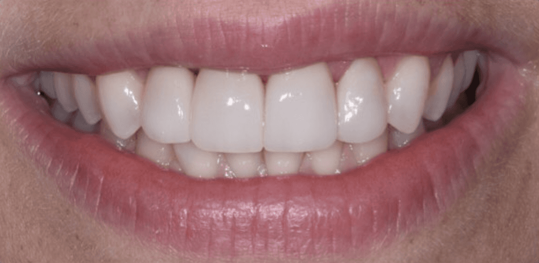 After four front veneers, encino ca