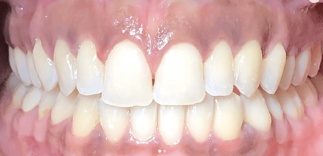 Mouth after invisalign, encino ca