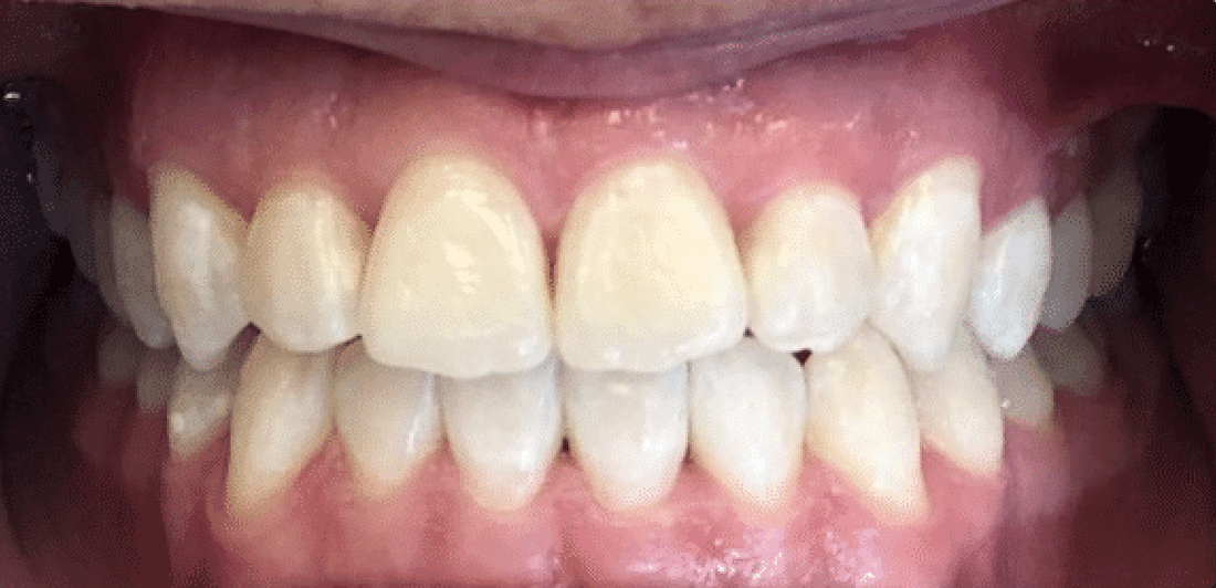 Full mouth after invialign, encino ca