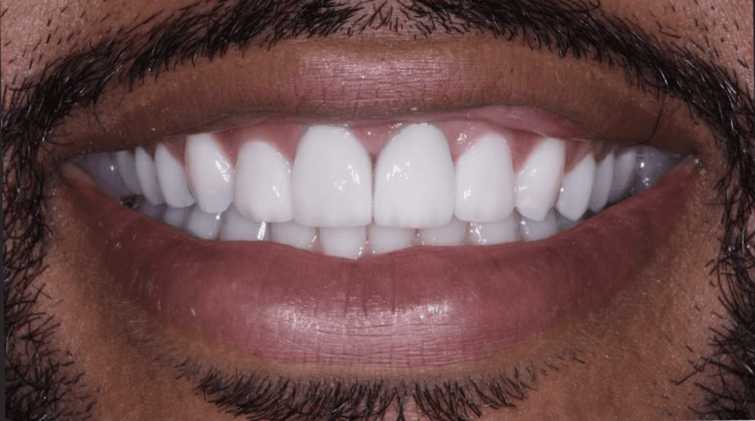 After porcelain veneers and crowns, encino ca