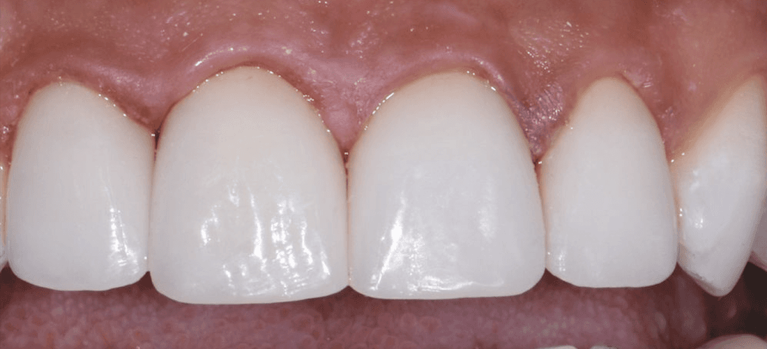 Mouth after porcelain veneers and crowns, encino ca