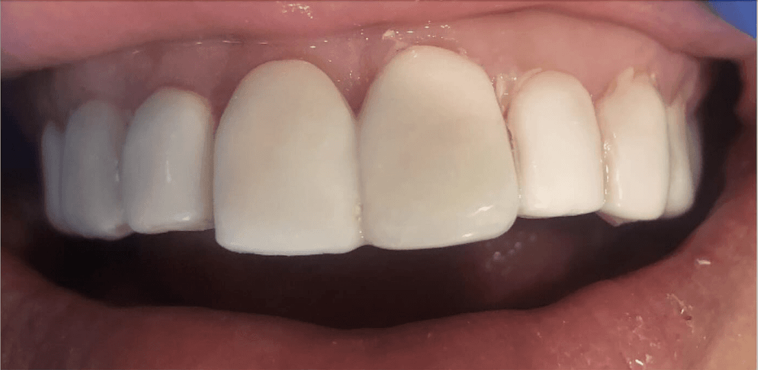 After porcelain veneers, encino co