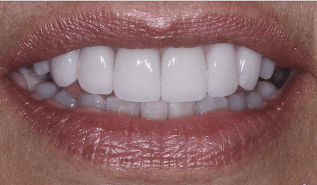 After full mouth porcelain veneers, encino co