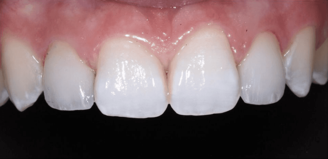 After veneers on two side teeth, encino ca
