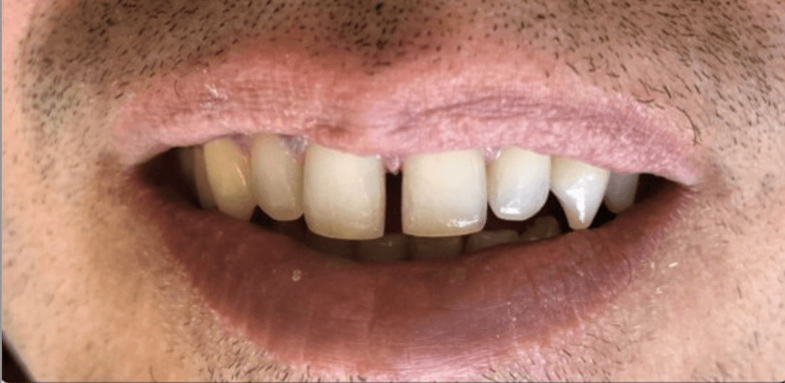 Before composite bindings, encino ca