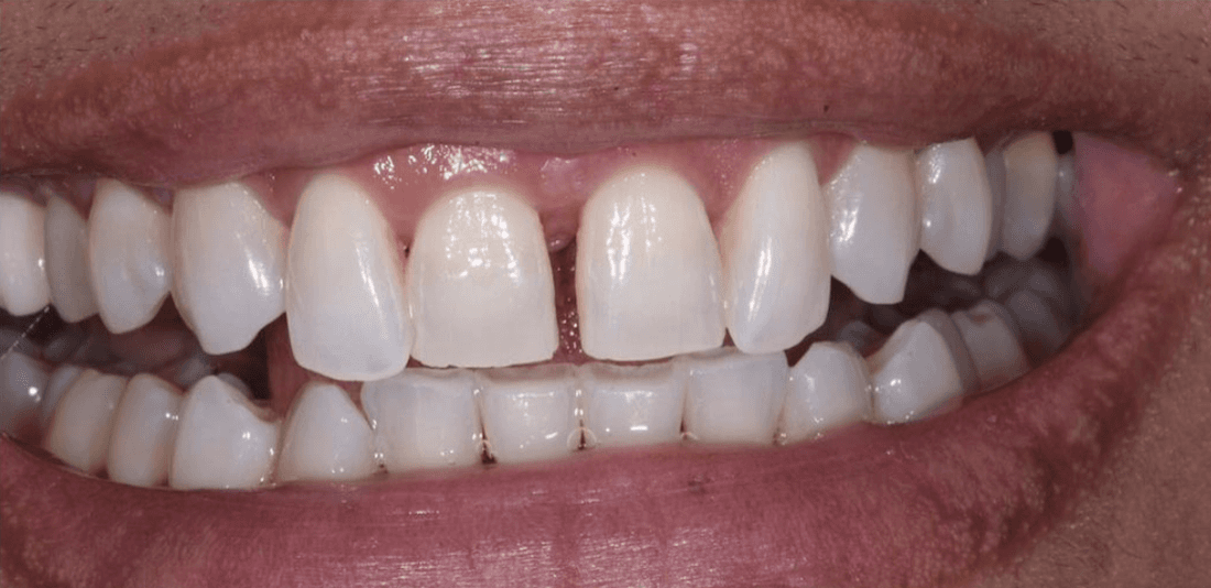 Before composite bondings, encino ca