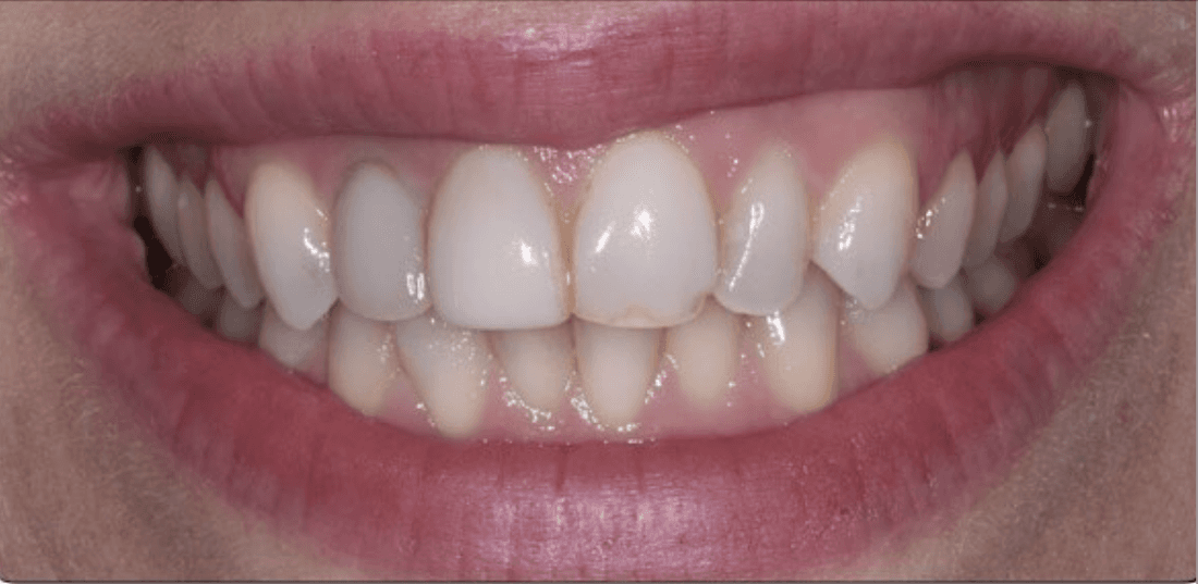 Before four front veneers, encino ca