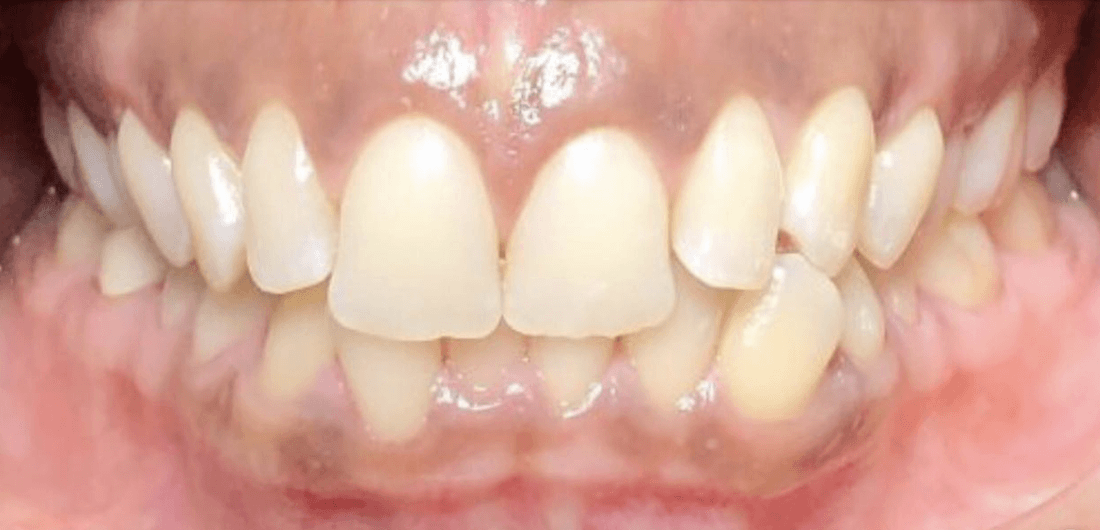 Mouth before invisalign, encino ca