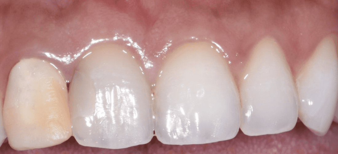 Mouth before porcelain veneers and crowns, encino ca