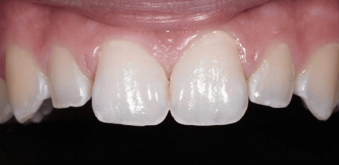 Before veneers on two side teeth, encino ca