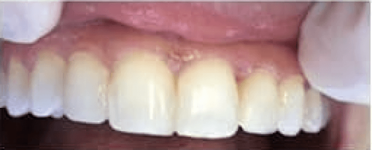 Mouth after composite bondings, encino ca