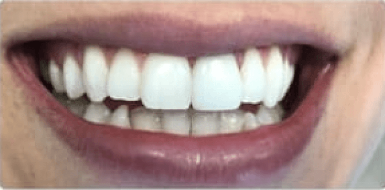 Teeth after dental crowns, encino ca