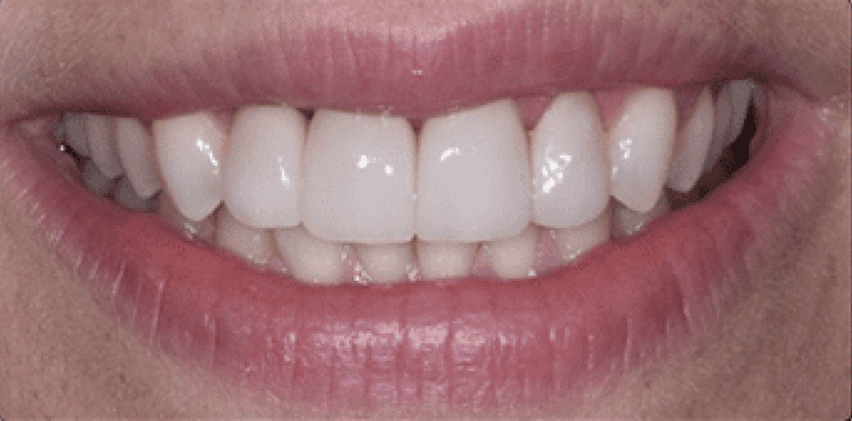 After four front porcelain veneers, encino ca