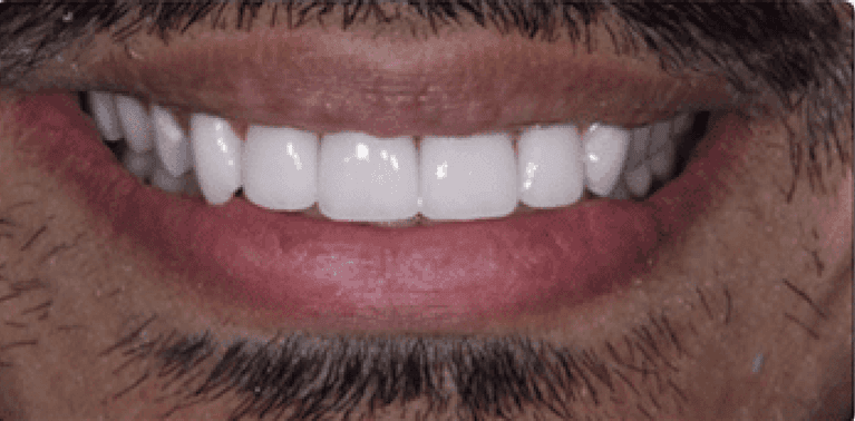 Mans mouth after four front porcelain veneers, encino ca