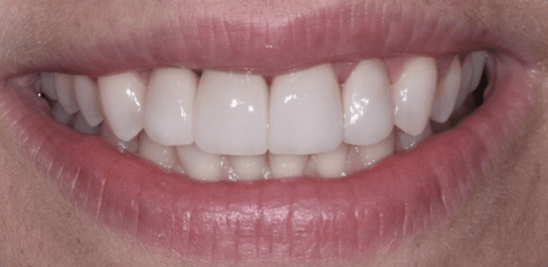 Four-Front-Veneers-After-Image