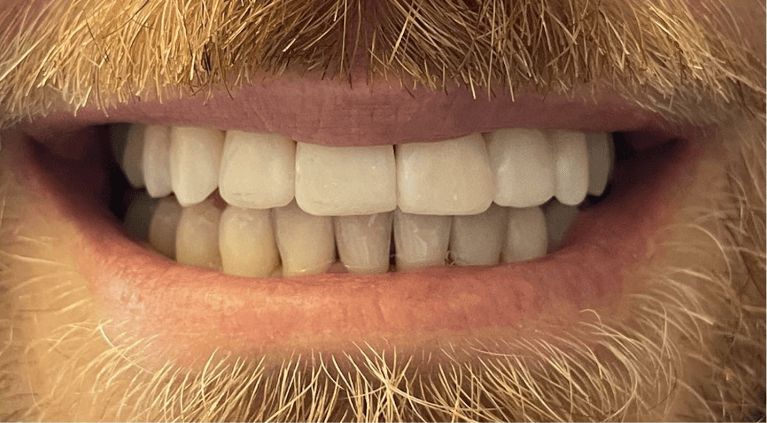 After invisalign and bondings, encino ca