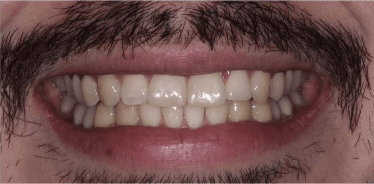 After invisalign and bondings on two front teeth, encino ca